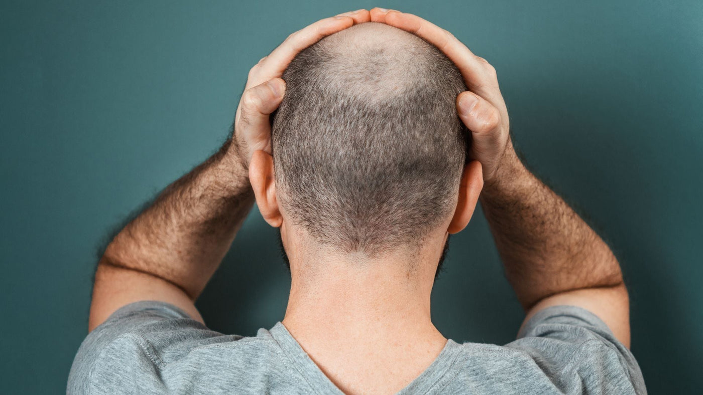 Is There Really a Cure for Baldness? Exploring the Latest Advances